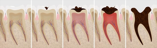 歯の寿命を延ばすための治療「歯内療法」にはマイクロスコープが必須！？