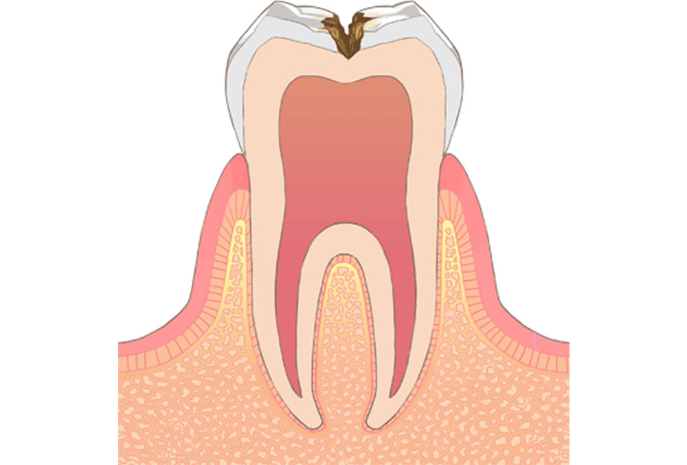 象牙質の虫歯(C2)