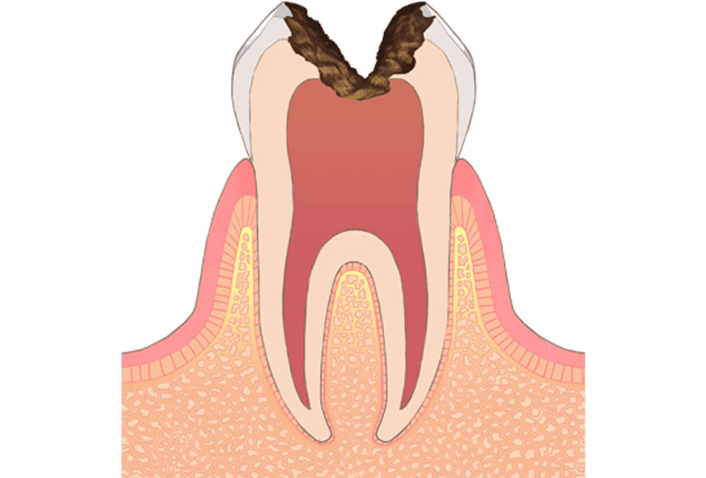 歯の神経に達した虫歯(C3)
