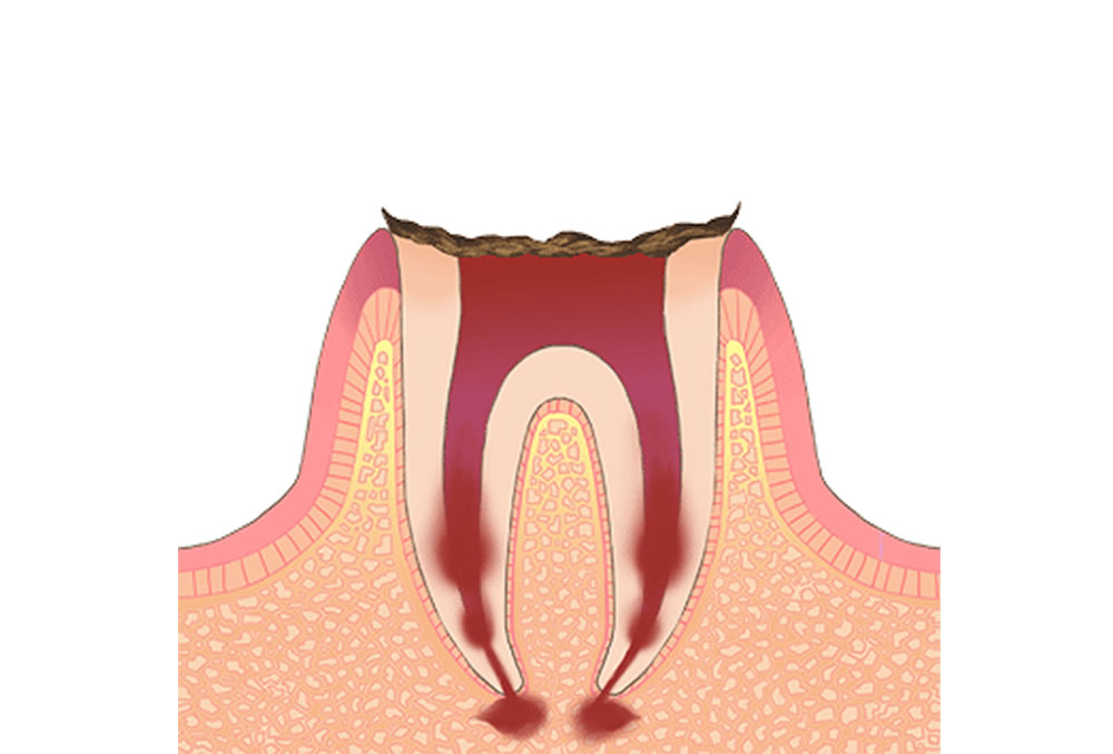 末期の虫歯(C4)