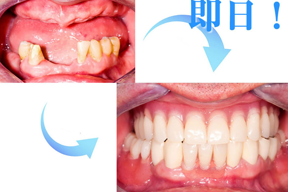 抜歯即時埋入法