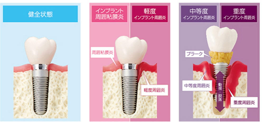 インプラントの歯周病